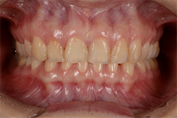 酸触歯の治療
