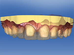 歯を360度ぐるりと削るオールセラミックのリスク