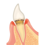 歯周病の進行と治療の流れ