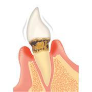歯周病の進行と治療の流れ