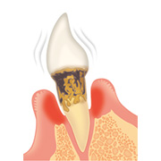歯周病の進行と治療の流れ