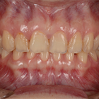 酸触歯の治療
